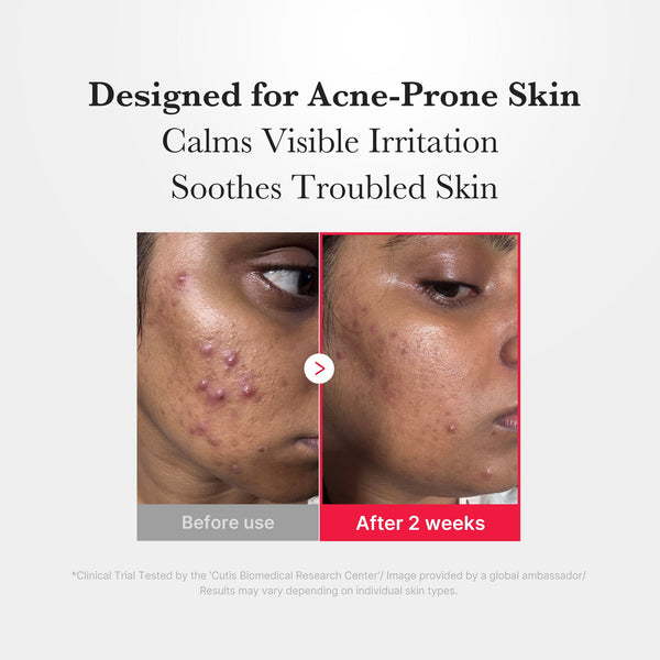 Hypochlorous Acid Power Soothing Spray for Acne Prone Skin