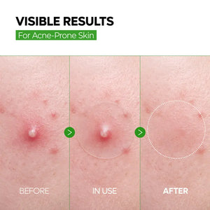 Blemish & Dark Spot Patch Duo with Salicylic Acid & Niacinamide