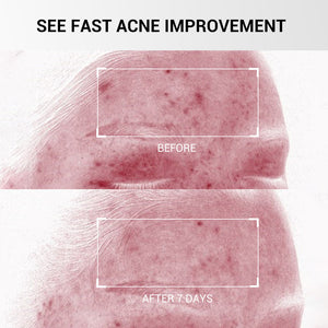 Salicylic Acid Drying Lotion with Niacinamide, Sulfur & Zinc Oxide for Acne