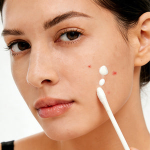 Salicylic Acid Drying Lotion with Niacinamide, Sulfur & Zinc Oxide for Acne