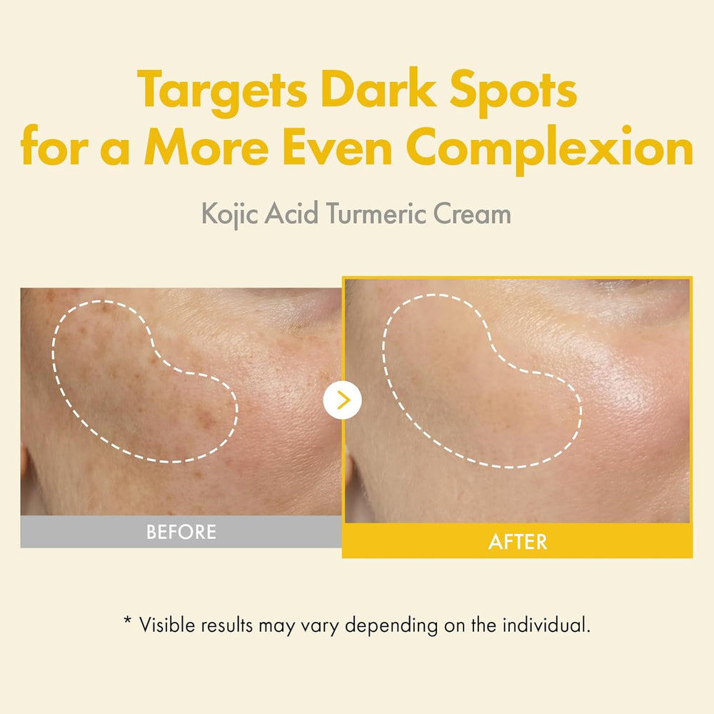 Kojic Acid Turmeric Cream for Dark Spots and Even Skin Tone