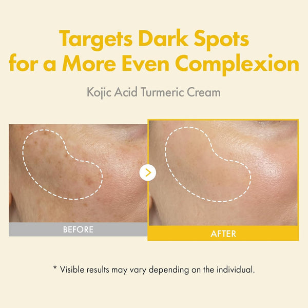Kojic Acid Turmeric Cream for Dark Spots and Even Skin Tone