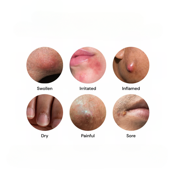 Close-up skin conditions showing swollen, irritated, inflamed, dry, painful, and sore areas commonly treated with Universal Flare Care