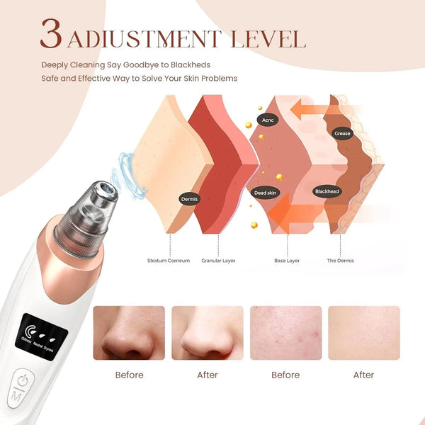 Blackhead Remover Pore Vacuum, USB Rechargeable, 3 Suction Levels