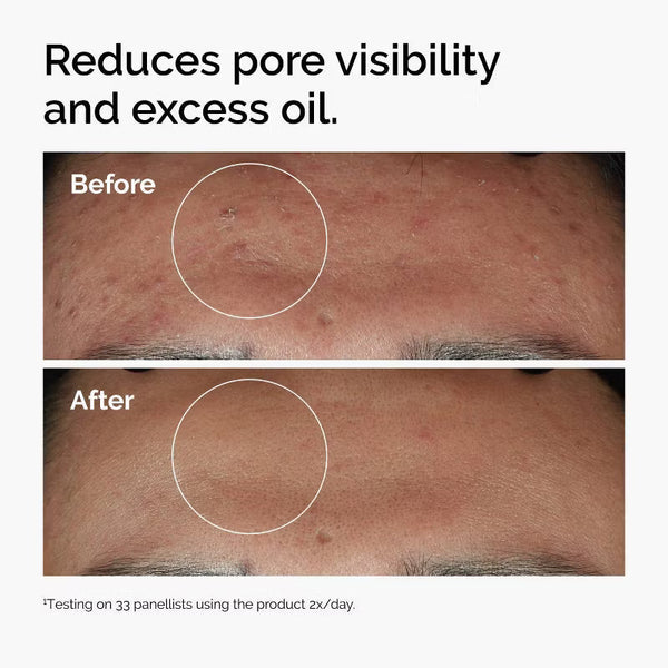 Niacinamide 10% Plus Zinc 1% Serum for Blemish-Prone & Uneven Skin 120mL