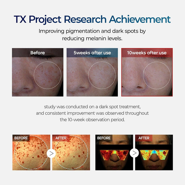 TX Tranexamic Acid Cream for Dark Spots, Freckles and Blemishes