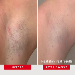 Bump-Smoothing Duo Ingrown Hair Pads & KP Scrub with Glycolic Acid